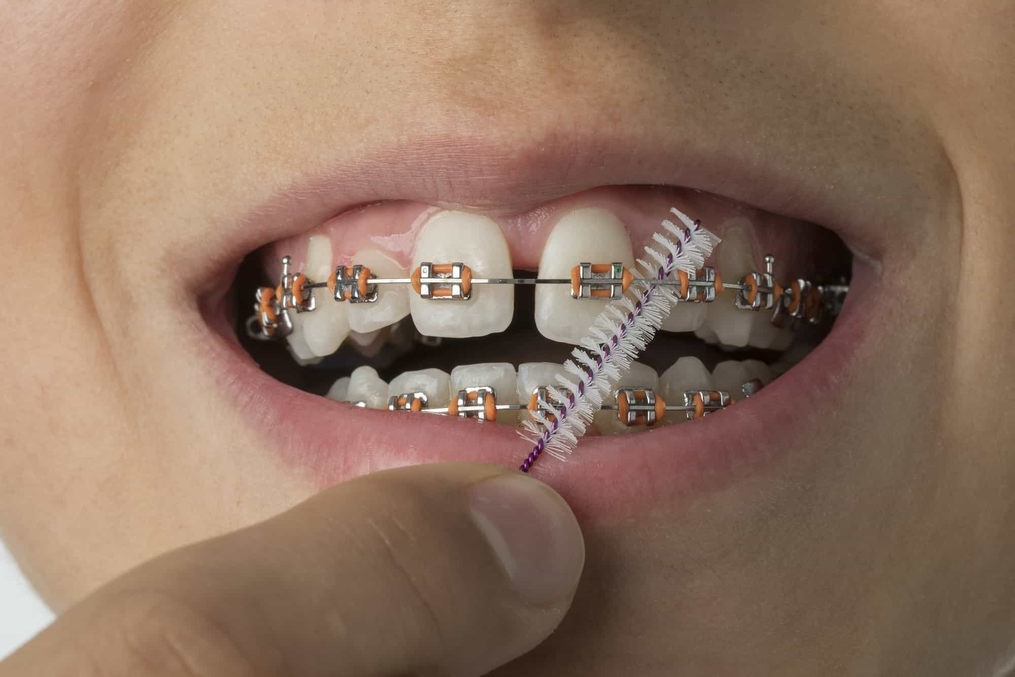 Quelles solutions pour les dents espacées proposez-vous ?